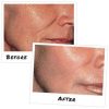 Glycolic Acid Peel 70% Deep+ Peel Unit