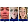SkinKick 2 Step Blemish Acne Treatment