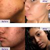4-Step Clear Skin System - Your Path to Blemish-Free Beauty