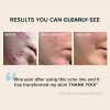Flawless Skin Awaits: Paula's Choice CLEAR Acne Power Kit