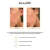 Acne-Clearing 3-Step Skincare Kit: Target Breakouts, Redness, and Dark Spots