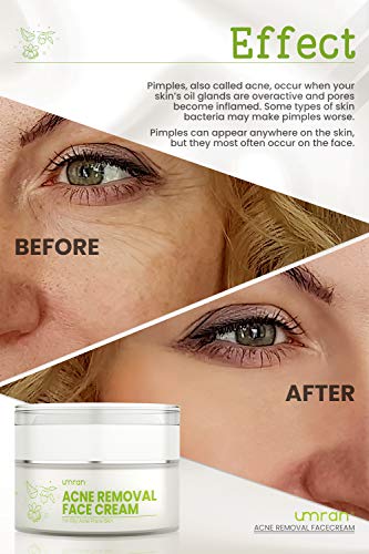 UMRAN Anti-Acne Treatment Cream, Acne Removal