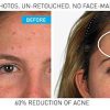 La Roche-Posay Effaclar Dermatological Acne Treatment - Image 4