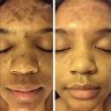 Dark Spot Corrector Remover for Face