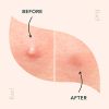 Rael Acne Pimple Healing Patch - Absorbing Cover