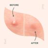Rael Acne Pimple Healing Patch - Absorbing Cover