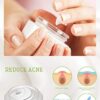Anti-Zits Treatment Cream - Natural Formula for Clear and Balanced Skin, Targets Breakouts, Spots, and Cystic Acne - Ideal for All Skin Types