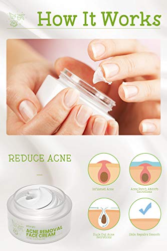 UMRAN Anti-Acne Treatment Cream, Acne Removal