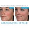 La Roche-Posay Effaclar Duo Dual Action Acne Treatment Cream - Clear, Radiant Skin with Gentle Care