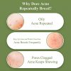 Acne Treatment Gel, BREYLEE Tea Tree Acne Spot Treatment
