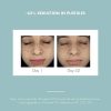 Acne Prone Mattifying Lotion Daily Moisturizer