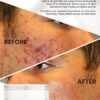 Anti-Zits Treatment Cream - Natural Formula for Clear and Balanced Skin, Targets Breakouts, Spots, and Cystic Acne - Ideal for All Skin Types