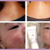Natural Eczema Lotion, Face Rash Cream, Clinically Tested