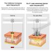 Achieve Salon-Quality Skin Tightening at Home – MLAY RF Facial & Body Machine