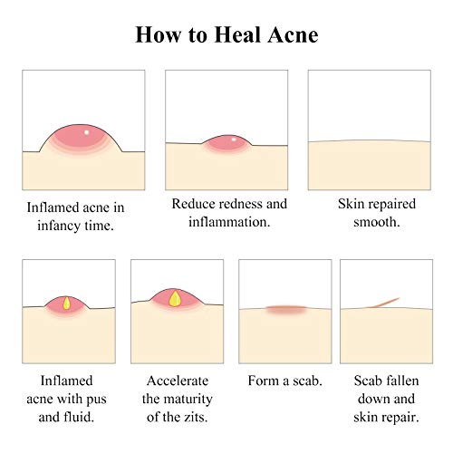 BREYLEE Tea Tree Clear Skin Serum for Clearing Severe Acne