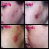 Dark Spot Corrector Remover for Face