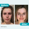 ProactivMD Adapalene Gel Acne Kit - Complete Retinol Moisturizer