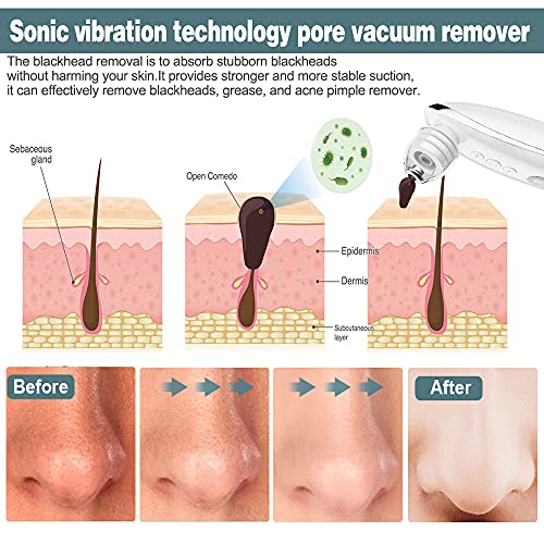 Acne, Grease, and Comedone Remover Vacuum with Camera