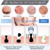 Eunon Blackhead Remover Vacuum - 2021 Upgraded