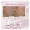 Hydrating Mattifying Gel Treatment Gel