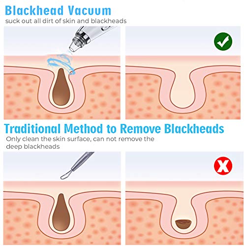 Newest Blackhead Remover Pore Vacuum