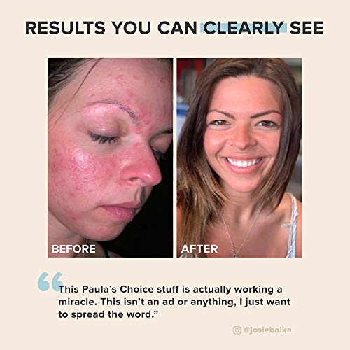 Flawless Skin Awaits: Paula's Choice CLEAR Acne Power Kit