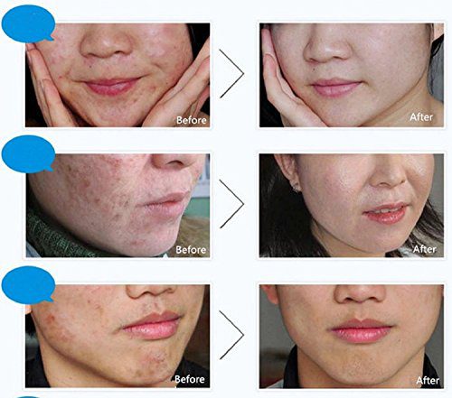 Scar Blemish Marks Face Skin Care Acne Anti-Wrinkle