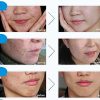BIOAQUA Face Skin Care Acne Anti-Wrinkle Treatment