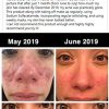 BREYLEE Tea Tree Clear Skin Serum – Powerful Acne Treatment with Camellia Sinensis Extract