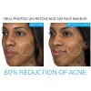 La Roche-Posay Effaclar Duo Dual Action Acne Treatment Cream - Clear, Radiant Skin with Gentle Care