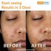 Pimple-Free 3-Step 24-Hour Acne Therapy Kit - Clinically Proven System with Oil-Free Cleanser, Witch Hazel Toner, and Acne Lotion - Benzoyl Peroxide Solution for Teens and Adults! 🌟 - Image 6