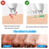 Blackhead Remover Pore Vacuum suitable for use by both men and women