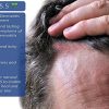 Seborrheic Dermatitis Cream with Manuka Honey, Coconut Oil & Aloe – Natural Relief for Itchy, Sensitive Skin