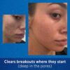 Acne Treatment with 0.1% Adapalene for Face