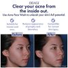 Obagi Medical CLENZIderm M.D. Daily Care Foaming Acne