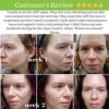 Apple Cider Vinegar Acne Face Toner Pads