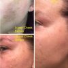 Dark Spot Corrector Remover for Face
