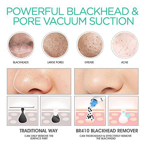 VOYOR Blackhead Remover Pore Vacuum