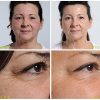 NIRA Skincare Laser – FDA-Cleared Anti-Aging Device to Reduce Fine Lines & Wrinkles
