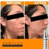 DRMTLGY Acne Spot Treatment and Cystic