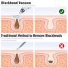 Blackhead Remover Vacuum with 5 Adjustable Suction Levels