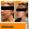 DRMTLGY Acne Spot Treatment and Cystic