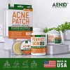 Cystic Acne Treatment and Acne Scar Remover