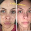 Dark Spot Corrector Remover for Face