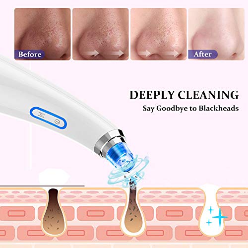 Blackhead Remover Vacuum and Acne Extracting USB Rechargeable