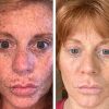 Dark Spot Corrector Remover for Face