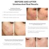 Murad 30 Day InvisiScar Acne Kit  - Skin Care Kit