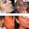 4-Step Clear Skin System - Your Path to Blemish-Free Beauty