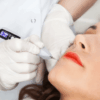 Get Flawless Skin with LONOVE's Laser Plasma Pen: A Safe and Effective Solution for Removing Freckles, Moles, Dark Spots, Warts, and More.